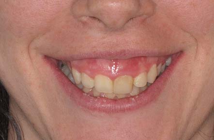 Sonrisa Gingival 1